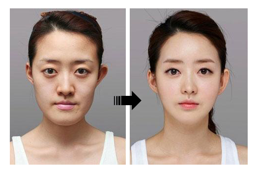 การศัลยกรรมใบหน้าตามแนวเกาหลี
